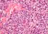European Commission Approves Label Variation for Brentuximab Vedotin